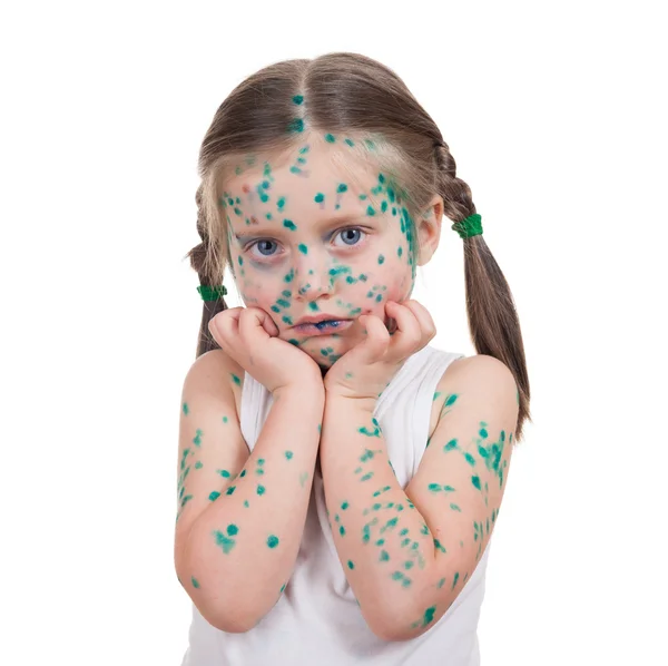 Acnes on child. chickenpox — Stock Photo, Image