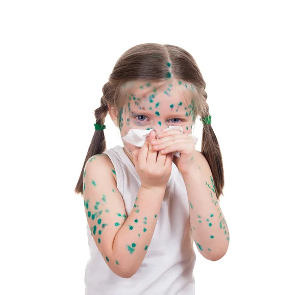 Acnes on child. chickenpox — Stock Photo, Image