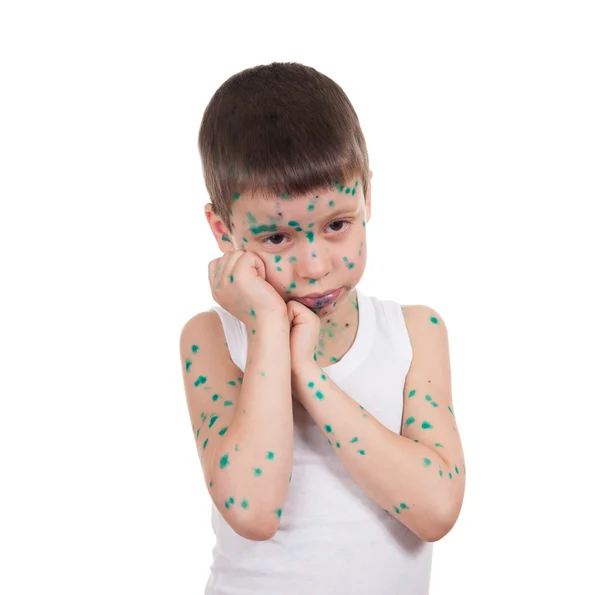 Acnes en el niño. varicela — Foto de Stock