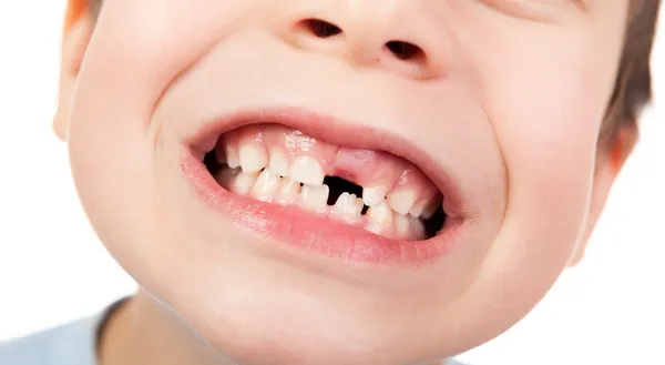 Boy face closeup with a lost tooth — Stock Photo, Image