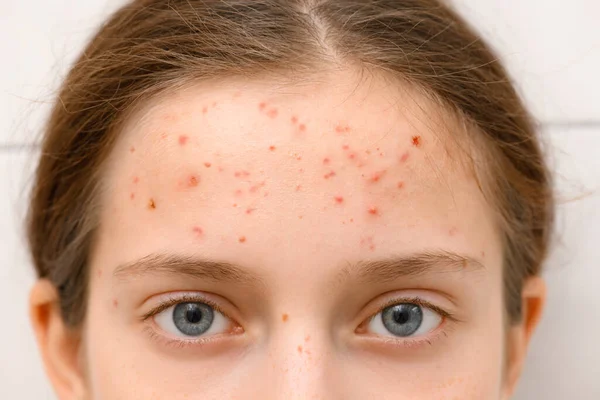 Gesicht Eines Teenagers Mit Pickeln Akne Auf Der Haut Porträt — Stockfoto