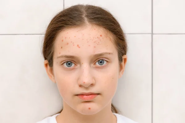 Cara Una Adolescente Con Granos Acné Piel Retrato Pubertad — Foto de Stock