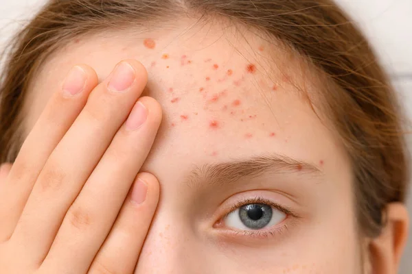 Rosto Uma Adolescente Com Espinhas Acne Pele Retrato Uma Menina — Fotografia de Stock