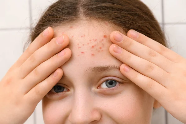 Gesicht Eines Teenagers Mit Pickeln Akne Auf Der Haut Porträt — Stockfoto