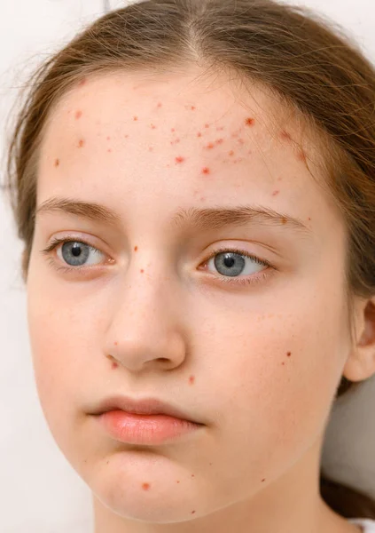 Rosto Uma Adolescente Com Espinhas Acne Pele Retrato Uma Menina — Fotografia de Stock