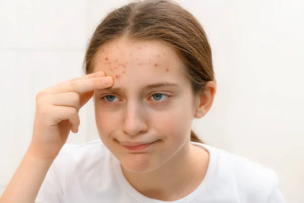 Disappointed Teenage Girl Looks Mirror Her Face Pimples Touches Her — Stock Photo, Image