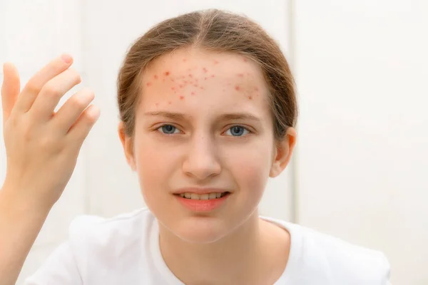 Disappointed Teenage Girl Looks Mirror Her Face Pimples Touches Her — Stock Photo, Image