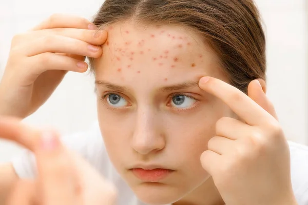 Portrait Teenage Girl Touches Her Face Pimples Acne Skin — Stock Photo, Image
