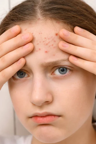 Retrato Uma Adolescente Toca Seu Rosto Com Espinhas Acne Pele — Fotografia de Stock