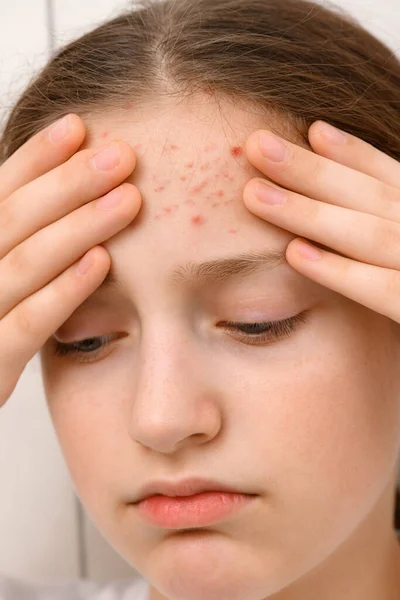 Retrato Uma Adolescente Toca Seu Rosto Com Espinhas Acne Pele — Fotografia de Stock