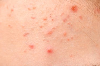 Sivilceli genç bir kızın yüzü, alnında sivilce, portresi