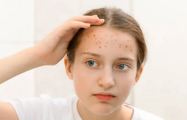 Retrato Uma Adolescente Toca Seu Rosto Com Espinhas Acne Pele — Fotografia de Stock