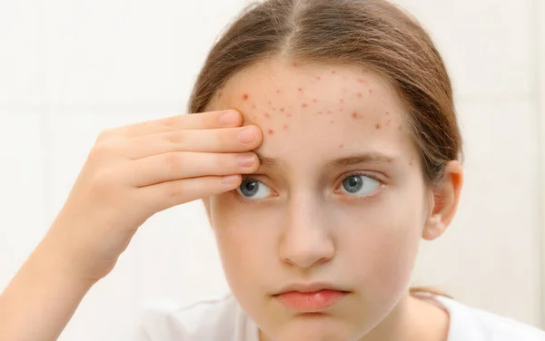 Portrait Teenage Girl Touches Her Face Pimples Acne Skin — Stock Photo, Image