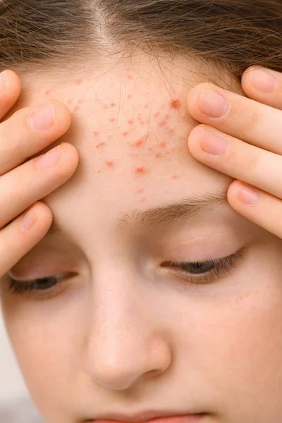 Retrato Uma Adolescente Toca Seu Rosto Com Espinhas Acne Pele — Fotografia de Stock