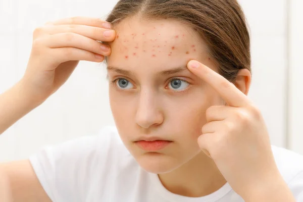 Retrato Uma Adolescente Toca Seu Rosto Com Espinhas Acne Pele — Fotografia de Stock