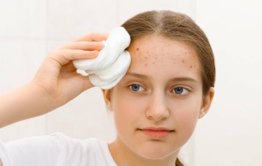 face of a teenage girl with acnes, she looks at herself in the mirror and takes care of her skin, does cosmetic procedures using a cotton pad