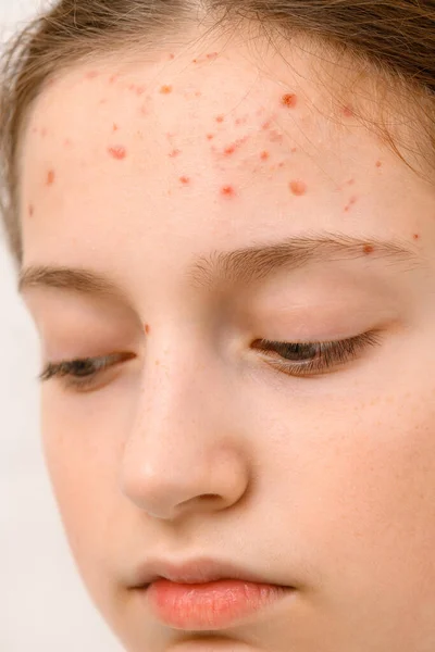 Rosto Uma Adolescente Com Espinhas Acne Pele Retrato Uma Menina — Fotografia de Stock