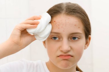 face of a teenage girl with acnes, she looks at herself in the mirror and takes care of her skin, does cosmetic procedures using a cotton pad