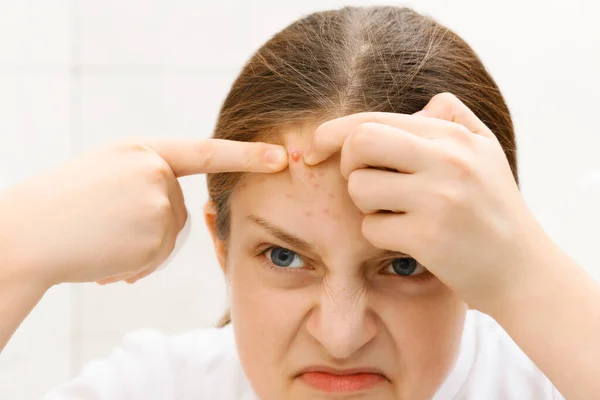 Retrato Una Adolescente Quita Las Espinillas Frente Toca Rostro Acné — Foto de Stock