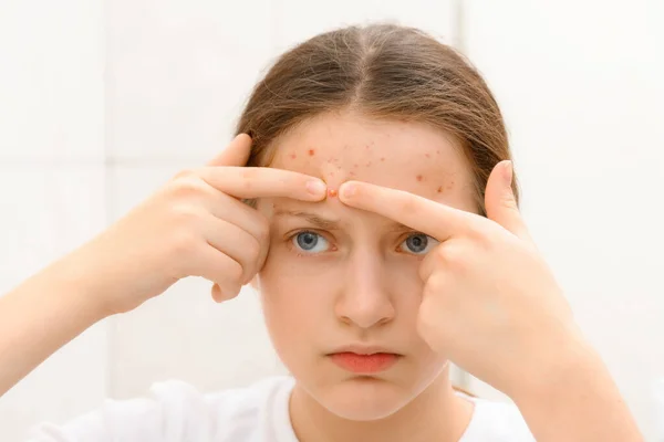 Retrato Uma Adolescente Toca Seu Rosto Com Espinhas Acne Pele — Fotografia de Stock