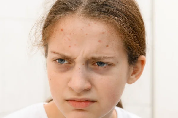 Нещасливе Обличчя Дівчини Підлітка Прищами Поганий Стан Прищі Шкірі Сумки — стокове фото