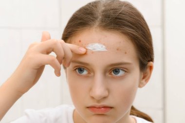 Kız yüzüne krem sürüyor, sivilceli genç bir kızın yüzü, cildinde sivilce, aynada kendine bakıyor, güzellik ve sağlık kavramı.