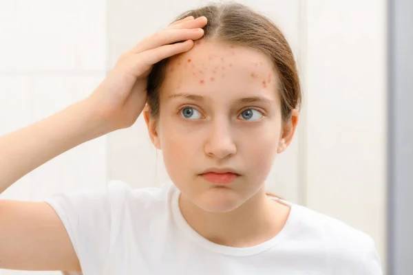 Retrato Uma Adolescente Toca Seu Rosto Com Espinhas Acne Pele — Fotografia de Stock