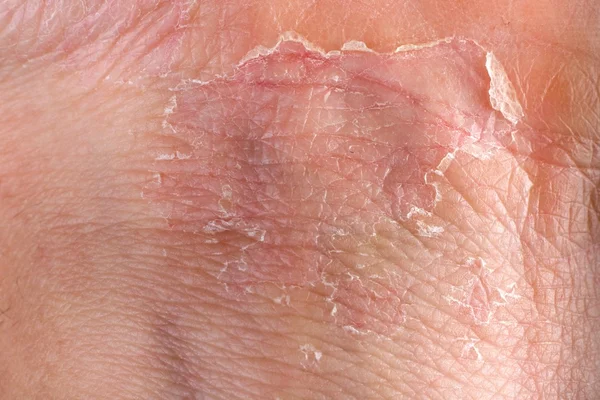 Eczema on skin — Stock Photo, Image