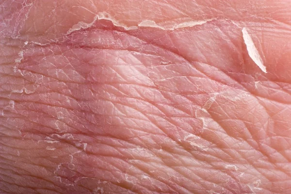 Eczema close-up — Fotografia de Stock