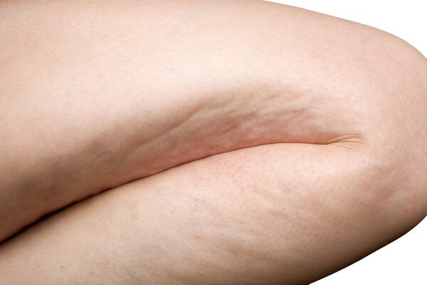 woman leg cellulite