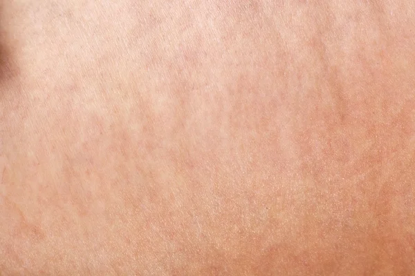 Antecedentes de celulitis — Foto de Stock