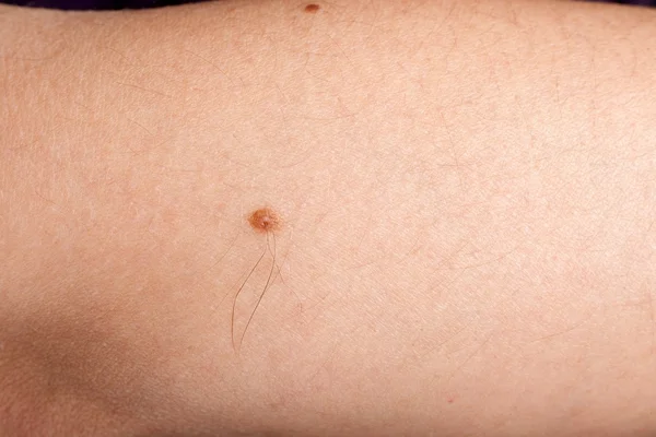 Melanoma en brazo de mujer — Foto de Stock