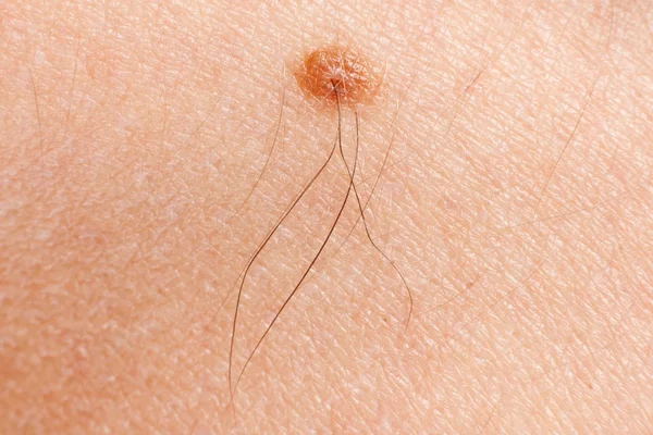 Melanoma na pele da mulher — Fotografia de Stock