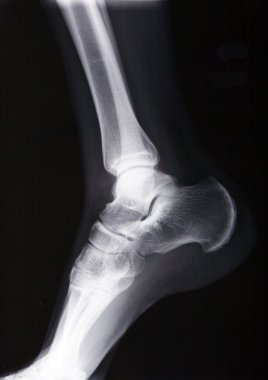 ayak bileği xray