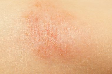 Çocuk ciltteki Egzama