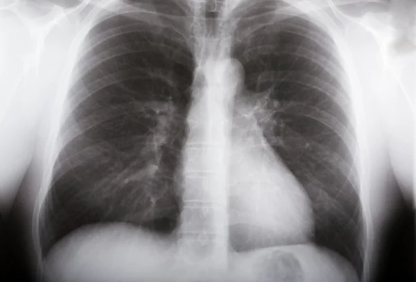 肺の x 線 — ストック写真