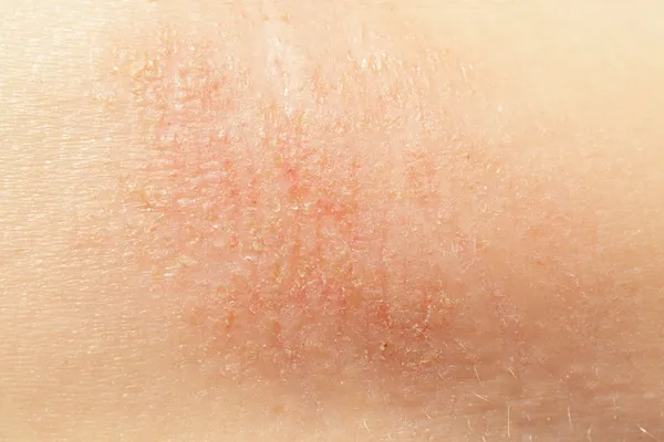 Eczema na pele da criança — Fotografia de Stock