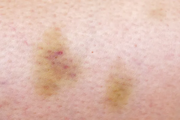 Woman skin bruise — Stock Photo, Image