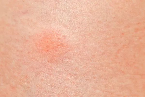 Mosquito pimple — Stock Photo, Image