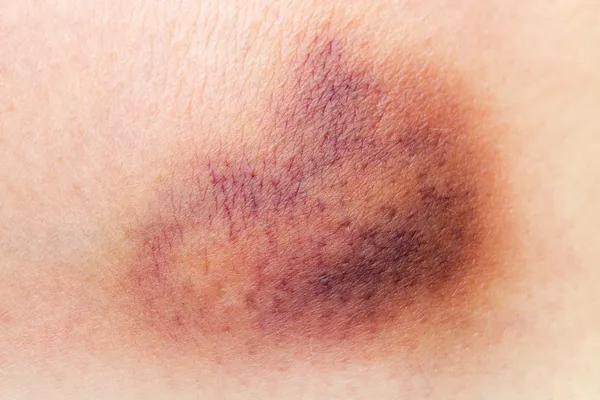 Bruise on skin Stock Picture