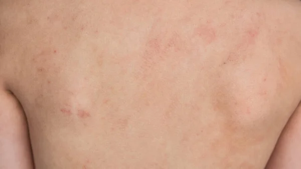 Primer Plano Chico Vuelta Con Eczema Piel Dermatitis Atópica Alergia —  Fotos de Stock