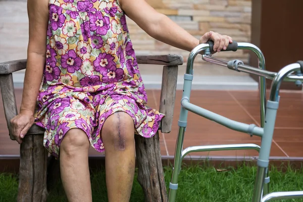 Old female patient hold walker frame and sit on wooden chair with suture scar at knee joint. Replacement surgery of left leg. Recovery after operation. healthy arthroplasty