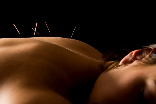 Acupunctura — Fotografie, imagine de stoc