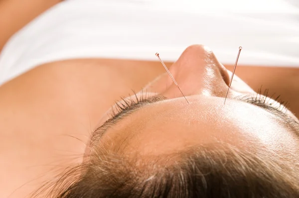 Acupuncture — Stock Photo, Image