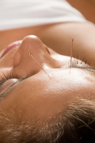 Acupuncture — Photo