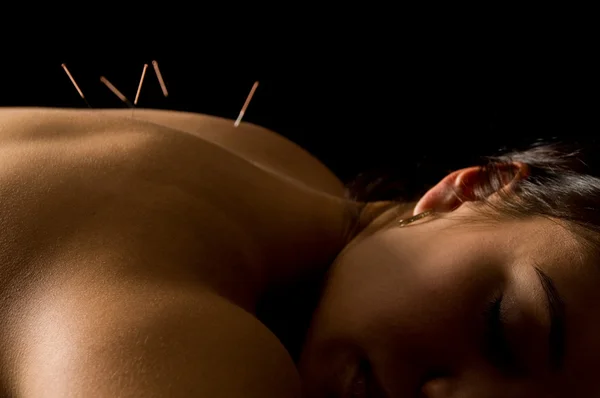 Akupunktur Stockbild
