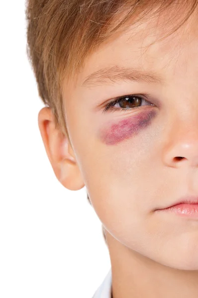 Boy with bruise — Stock Photo, Image