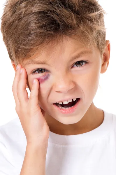 Boy with bruise — Stock Photo, Image