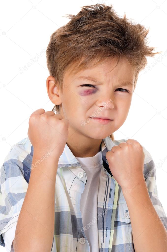 Boy with bruise