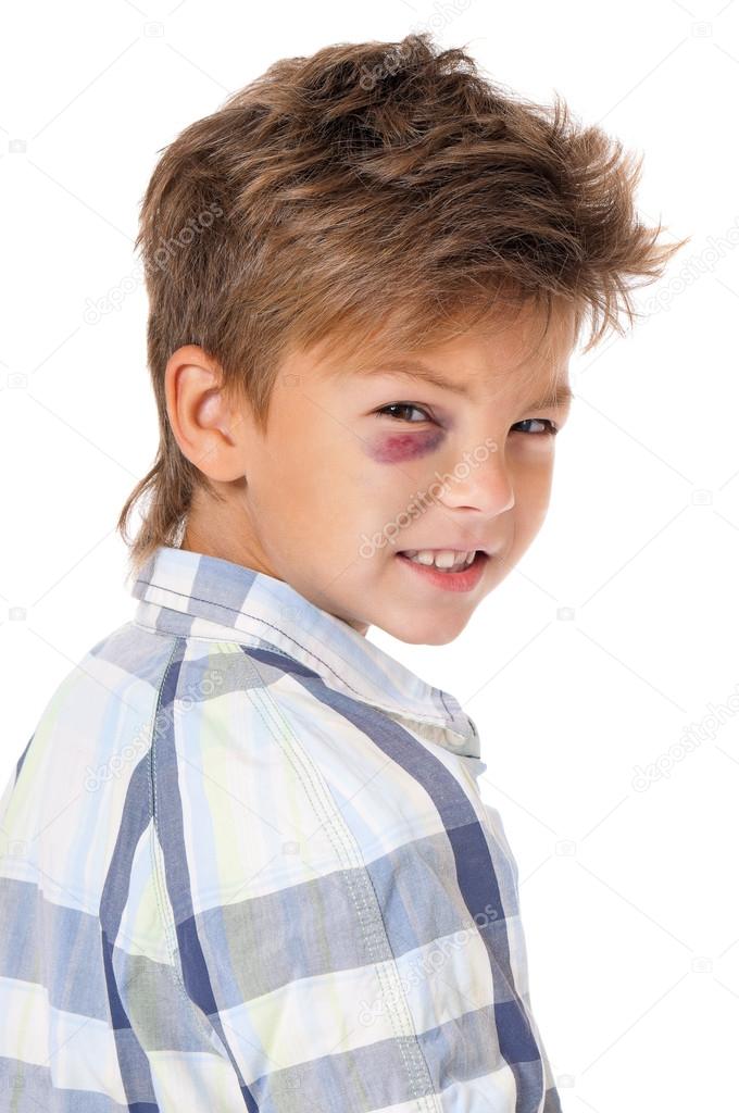 Boy with bruise